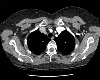 CT chest scan