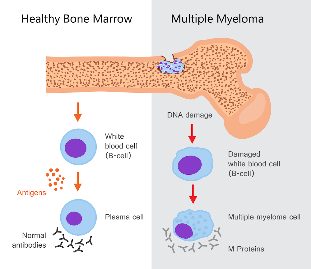 Multiple Myeloma Program  Rutgers Cancer Institute of New Jersey