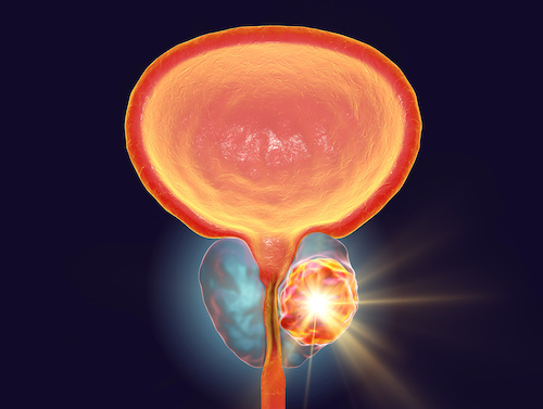 3D illustration showing destruction of a tumor inside prostate gland