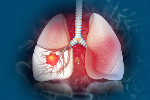 illustration of lungs with inflamed tumor highlighted