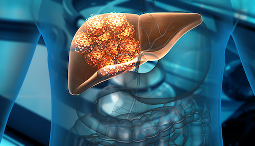 illustration of liver with cancer cells
