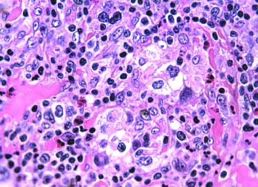 illustration of hodgkin lymphoma cells under a microscope