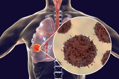 Graphic image of a tumor on the lung