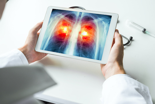 Doctor holding tablet that is displaying scan of lungs