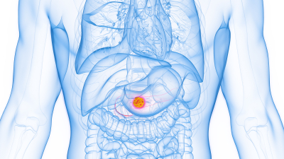 Image of pancreas tumor