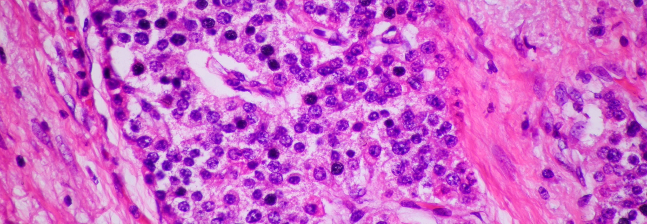 Close up of microscopic slide of endocrine cancer cells