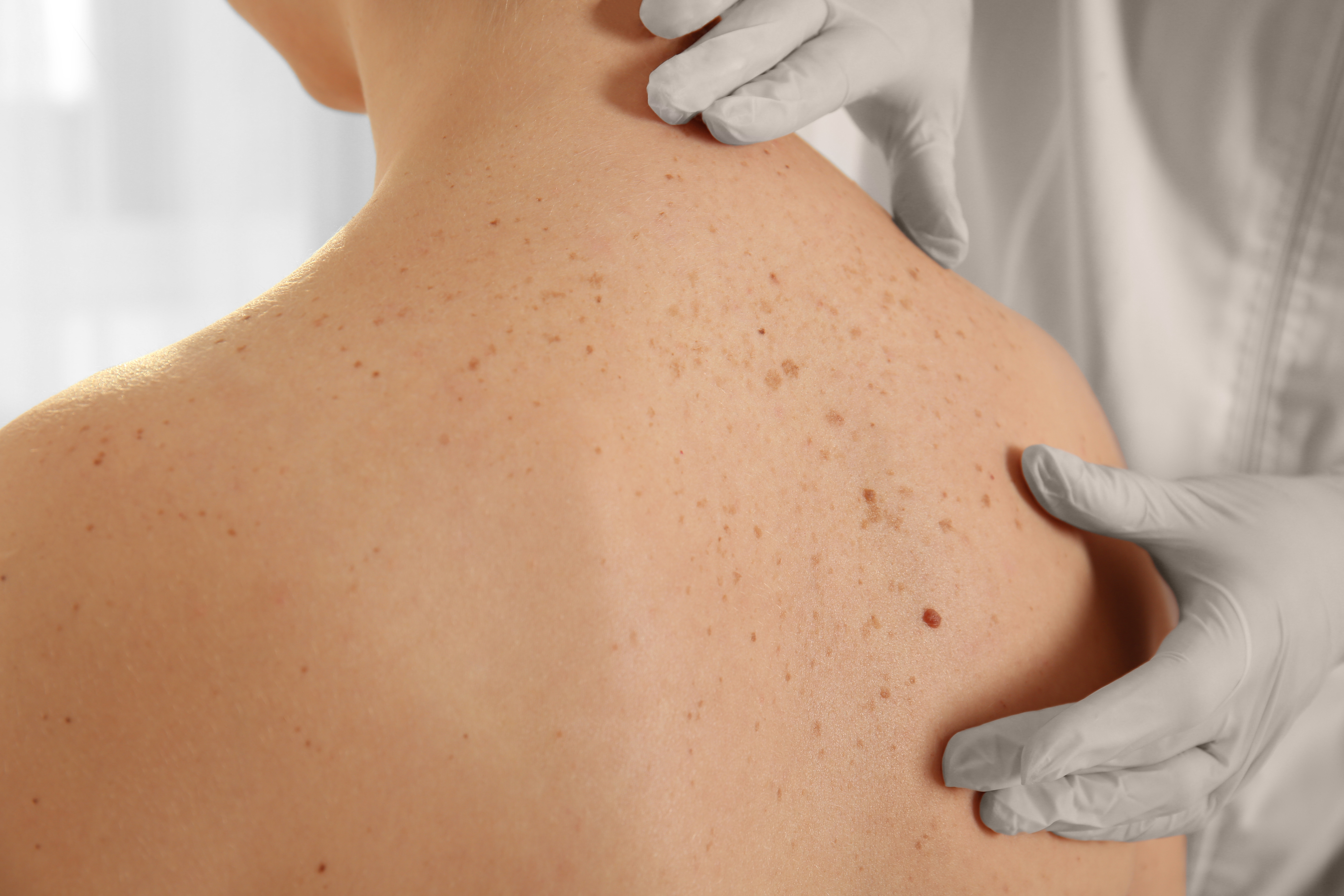 Doctor examining skin of patient's back while they sit on table