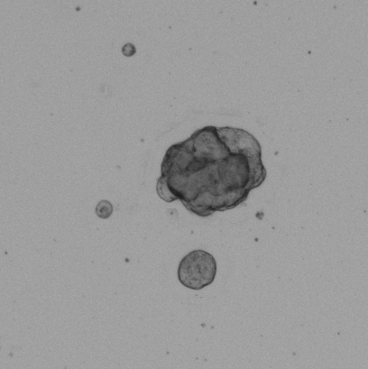 Colon Tumor Organoid Culture 5D