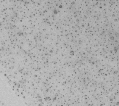 Lung Tumor Organoid Culture 1D