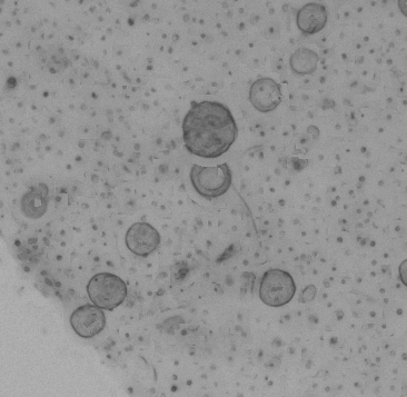 Lung Tumor Organoid Culture 1D