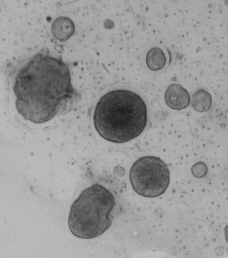 Lung Tumor Organoid Culture 1D