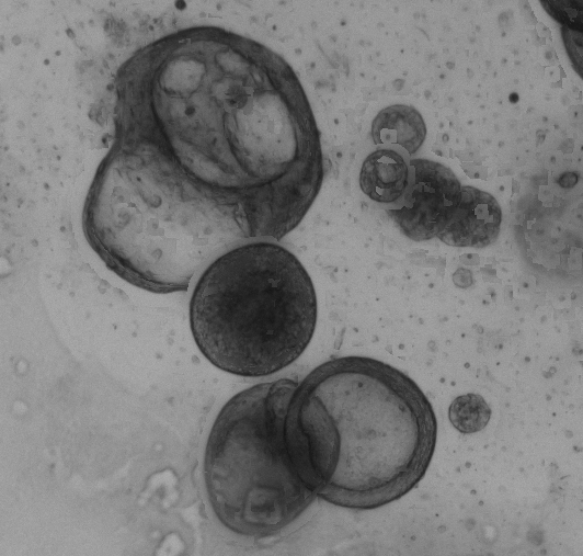 Lung Tumor Organoid Culture 1D