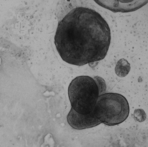 Lung Tumor Organoid Culture 1D