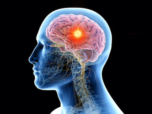 3D rendered medically accurate illustration of the human brain and a tumor