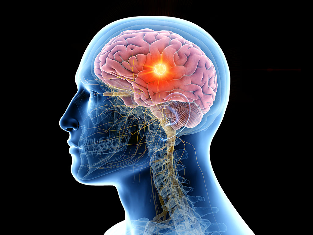 3d rendered medically accurate illustration of the human brain and a tumor
